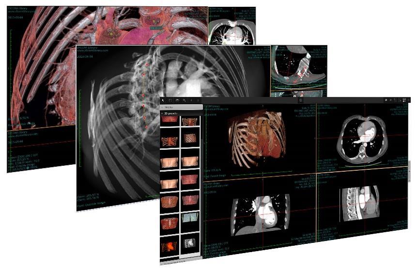 MedDream 3D module MedDream 3D module simplifies reconstruction techniques for three dimensional visual representations of two dimensional image slices.