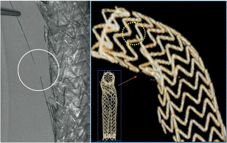 Middle, At 12-months, the separation has started to occur, leaving only a two-stent overlap.