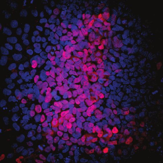 DATA EXAMPLES Brachyury/DAPI Figure 1: Differentiation of Pluripotent Stem Cells into Mesoderm.