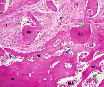 H&E stained histological images at 100x magnification showing implanted graft remodeling. Both grafts were actively involved in remodeling.