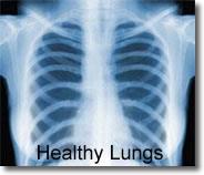 Lung Disease - All are irreversible.