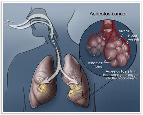 Latency Period Asbestosis 15-30