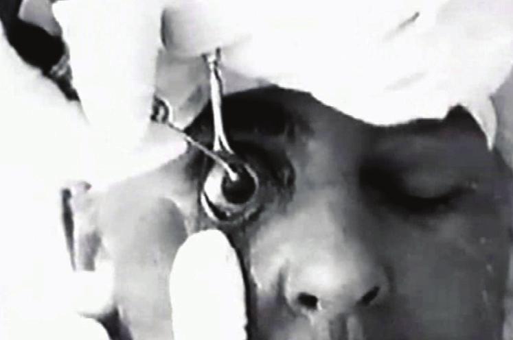 Figure 2. Ignacio Barraquer removing a cataract with the erisophake technique. devised a means of removing the cataract without the need for a capsulotomy.