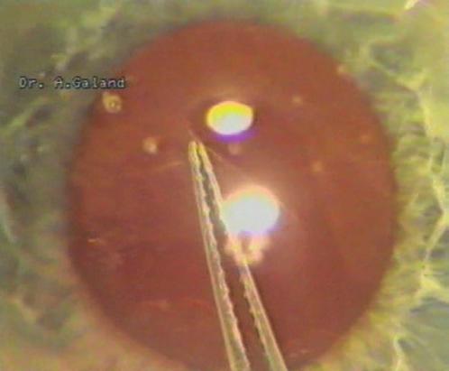 Fercho, MD, Larry Benjamin, MD, and Albert Galand, MD, PhD) EVOLUTION OF THE CAPSULOTOMY IN PICTURES A capsular bag or in the ciliary sulcus.
