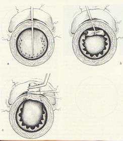Albert Galand, MD, PhD, an advocate of ECCE, designed his envelope technique in order to make more certain that the IOL was in the capsular bag (Figure 4D).