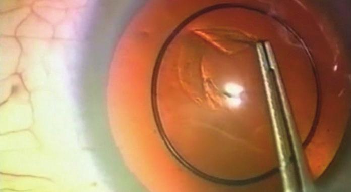 Additionally, one of the issues in obtaining accurate visual outcomes from biometry is predicting the IOL s postoperative effective lens position (ELP).