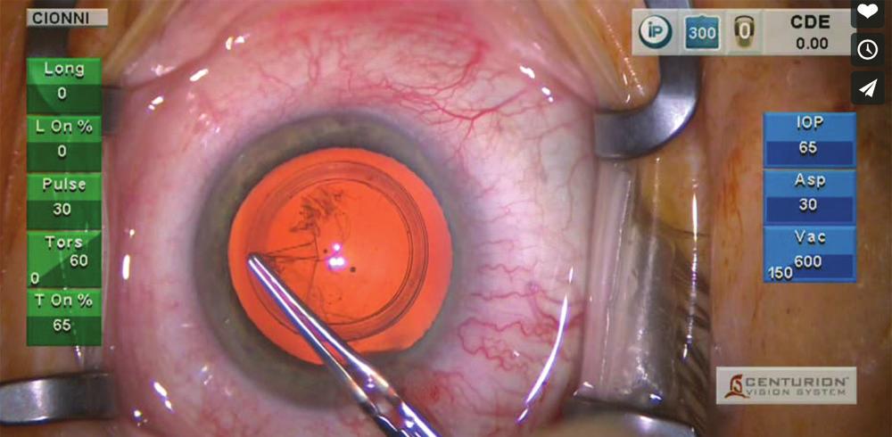 Figure 2. Robert Cionni, MD, creating a CCC with the Verus. WATCH IT NOW Aaron Waite, MD, shows his first experience with the Verus device. typically 30 to 45 seconds to any cataract case.