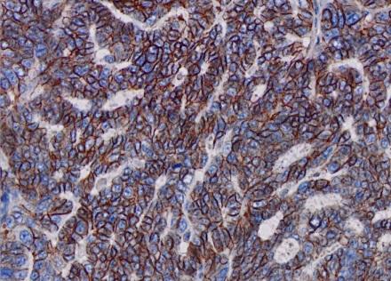 Cholangiocarcinoma Endometrial cancer Head and neck cancer Non-small cell