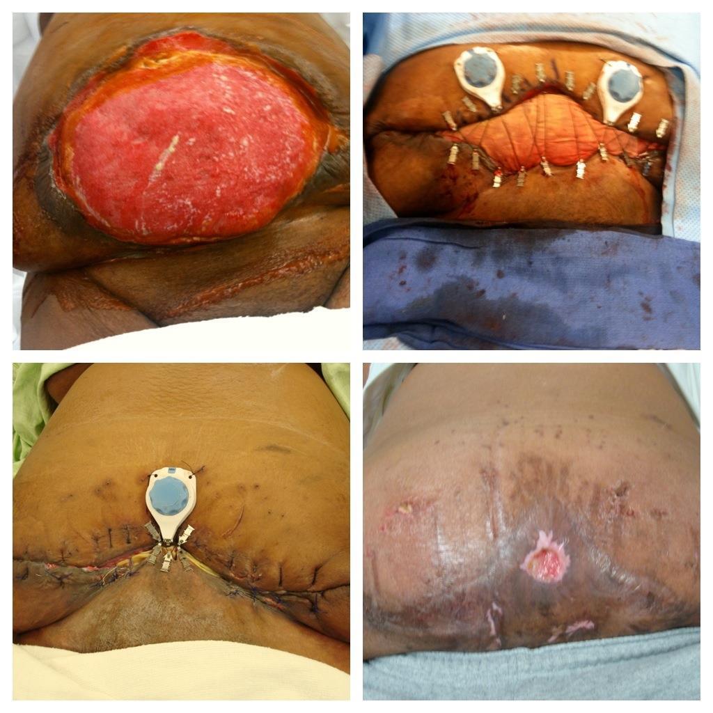 Open Abdomen Intra-Operative After