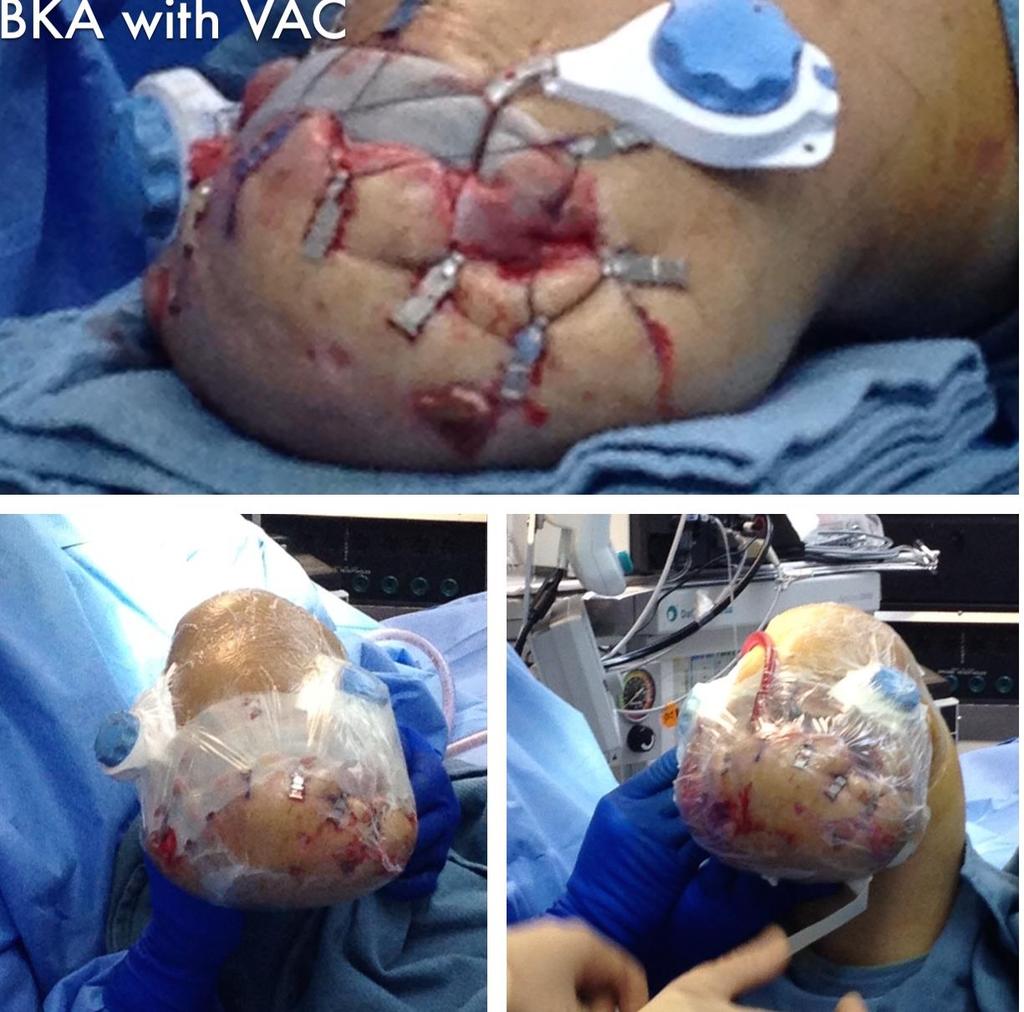Amputation BKA with VAC DermaClose helps