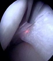 In Laser Diskectomy it removes residual nucleus pulposus material in preparation for stabilisations and fusions.