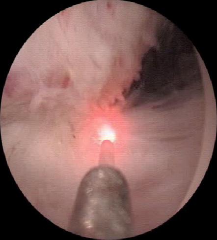 Nasal and laryngeal polyps can easily be removed. All of these procedures can be performed as outpatient treatments.