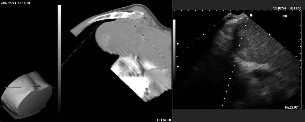 Fig. 4 RVS (CT MPR and real time ultrasound image) Courtesy of Dr. Iwasaki in Tohoku University 4.