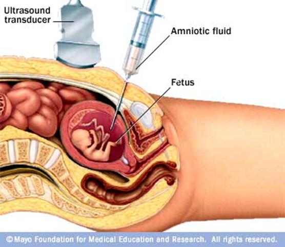 Amniocentesis A small amount of amniotic fluid around a fetus is taken.