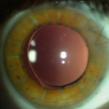 Laser Cataract Surgery 4 Indications Other clinical benefits of FS laser cataract 1. Capsulotomy up to 10x more precise 2.