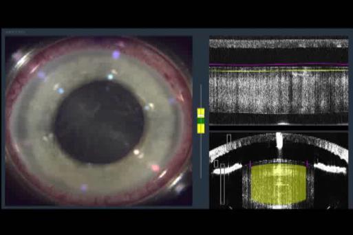 Abell et al, Clin Exp Opthal 2012, in press.: Conrad Hengerer et al. JCRS Sept. 2013. Catalys. Other clinical benefits of FS laser cataract The future is femto.