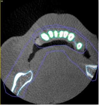 ROI zuba povezana. Zbog toga se koriste Bulove operacije (unija dva objekta) gde se kao rezultat dobija jedinstveni 3D model donje vilice.
