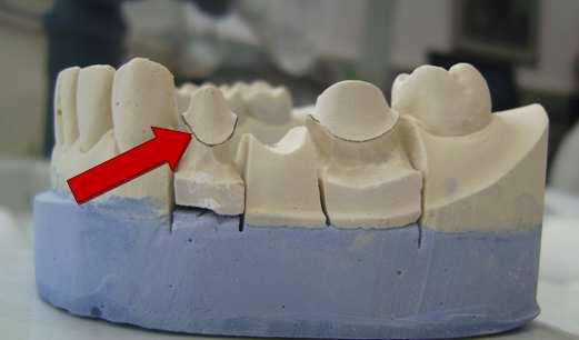 The plaster model that would otherwise be used for wax modelling can be used, but additional preparation can be required in order to achieve proper feature recognition functionality inside computer