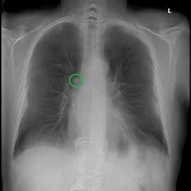 Improved identification of cases that require follow-up (1.5 times more sensitive than two-view CXR without decreased specificity). Improved conformity with guidelines for patient follow-up and care.