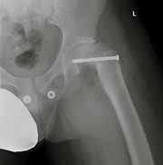 A 13-year-old patient arrived post-surgical with extreme hip pain.