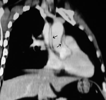 Why Gate Thoracic CTA Reduces motion artifact in ascending aorta