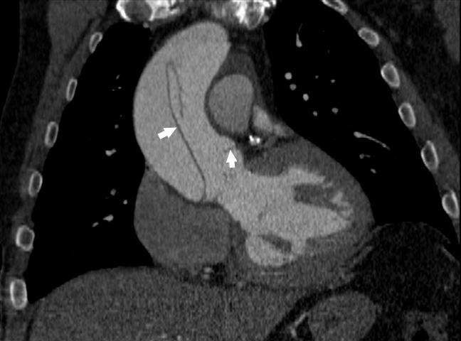 Cardiac Gated Thoracic Aortic CTA