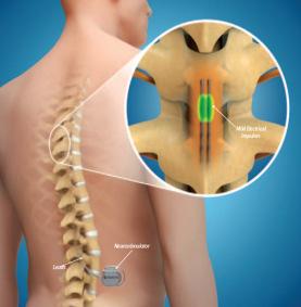 Li-Ion Battery in Implantable Medical Devices Since 2004 Since 2010 Spinal Cord Stimulators Mild electrical stimulation in the spinal cord to alleviate chronic pain.