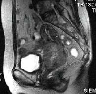 the Treatment After the Treatment MRI