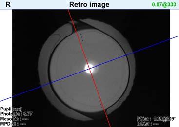 properly. Axis Off One Day Post Op Multifocal IOLs are Not for Everyone!