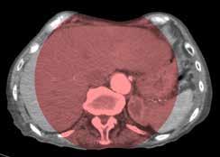 Complete coverage of the liver during cone-beam CT imaging allows for improved depiction of peripheral hepatic tumors. Schernthaner RE et al. Radiology.
