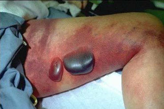 Clinical aspects of Gas Gangrene Gas gangrene usually begins 1 to 4 days after the injury