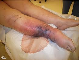 The earliest reported finding is severe pain at the site of the wound associated with a