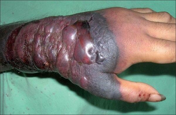 The disease then progresses rapidly with edema, tenderness, discoloration and hemorrhagic