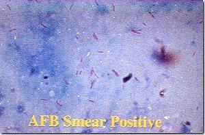 Phenotype what something looks like or does Genotype DNA, genes AFB Acid Fast Bacilli; Mycobacteria