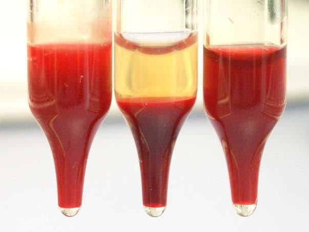 Conversion of Whole Blood into Cell-Disintegrated Blood (CDB) CDB : Homogenous, red-coloured blood specimen containing the complete matrix but no cellular components which sediment In-line Processing