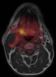 localized in the PET/CT fused images (right panel). Figure 2.