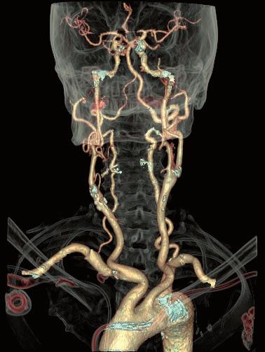 Case 3 Detailed Head & Neck CT Angiography at Low Dose A man in his 70s was referred to CT for follow-up of a stenosis of the right internal carotid. - Helical mode - Pitch 0.