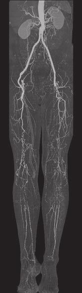 Case 4 Low-dose and High-resolution Runoff CT Angiography A man in his 60s was referred to CT for follow-up of lower limb arteriopathy. - Helical mode - Pitch 0.