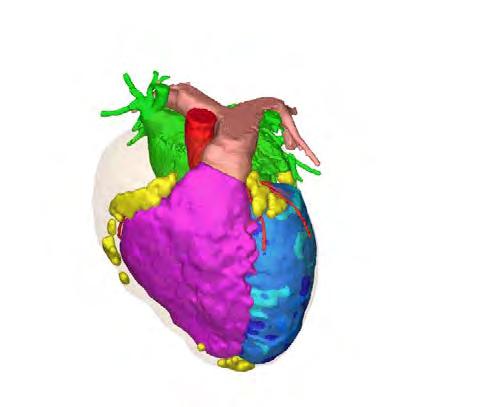 SHEFFIELD Interventional Example Ventricular Tachycardia Ablation Detailed 3D models derived from imaging: CT, MRI & NM Model used directly during the ablation procedure