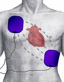 Applying Jidoka in Healthcare The Automated External Defibrillator or AED Defibrillation uses a specific machine (defibrillator) to shock a person's heart back into a