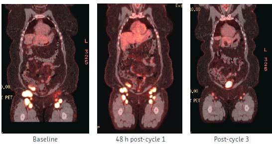 Copanlisib Potential New Treatment for Patients with Non-Hodgkin s Lymphoma 18 FDG-PET scans of a follicular lymphoma patient with partial response PI3k inhibitor targeting liquid tumors Phase II in
