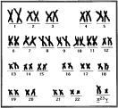 Genetic Disorders (Continued) 4. Turner syndrome: : sex chromosomes fail to separate in meiosis. Females only, 45 X, there is a missing X chromosome 5.