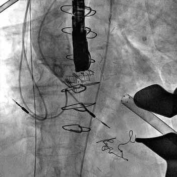 Angiography after balloon post-dilatation showing no residual paravalvular leak.