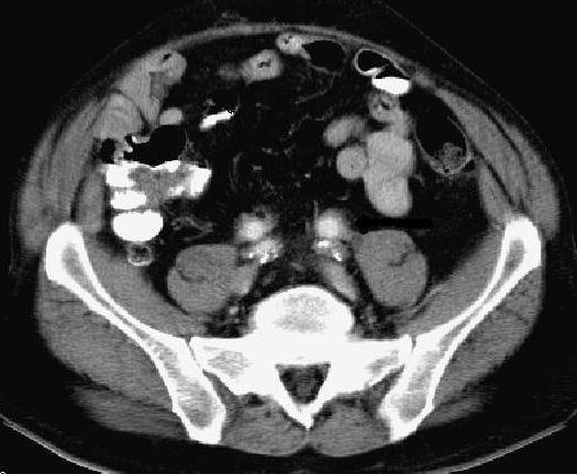 CT Scan Good for obvious signs: Perigraft fluid/air Pseudoaneurysm Aortic