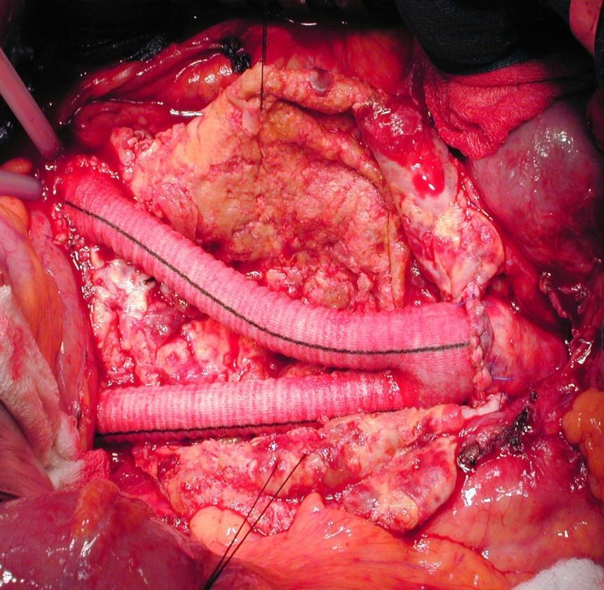 Aortic Grafts Widespread use since 1954 Excellent