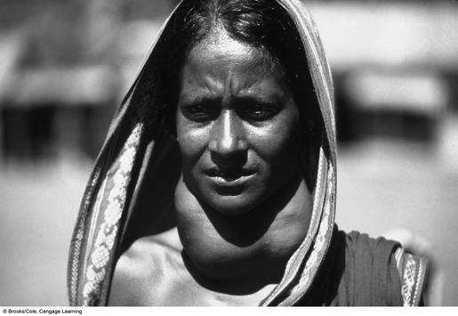 Woman with Goiter in Bangladesh Acute Food Shortages Can Lead to Famines