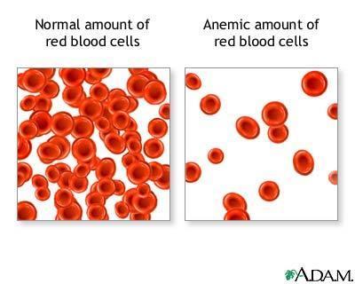 RBC Disorders Polycythemia vera (PCV ~ 60-70%) Anemias (O 2 carrying capacity too ) Hemorrhagic anemia Fe deficiency anemia Hemolytic