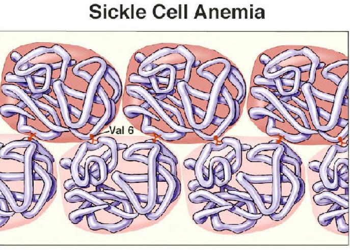 Sickle cell anemia occurs when an individual inherits two recessive alleles (ss). Sickle cell trait exists when one inherits the heterozygous condition (Ss).