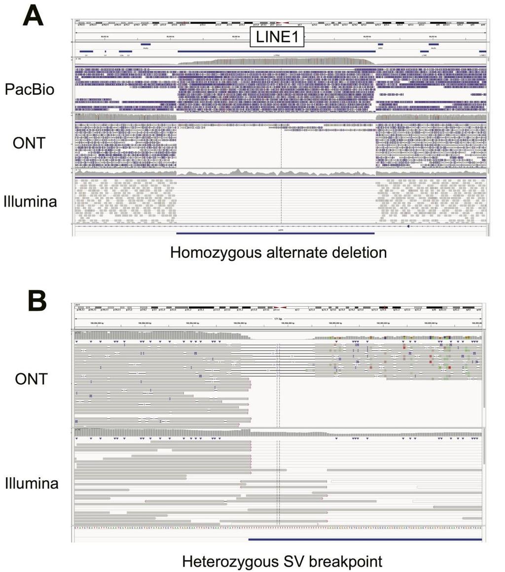 Supplementary Figure 8 Alignment artifacts complicate SV genotyping A) Illustrative IGV screenshot of an expected homozygous alternate deletion (interval displayed at bottom), with PacBio, nanopore,