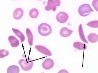 The classic molecular human disease: Sickle cell, HbS Normal RBC 6-8 µm; 4e12 per L Sickle cells; HbS 1949 Castle & Pauling Single nucleotide polymorphism (SNP)